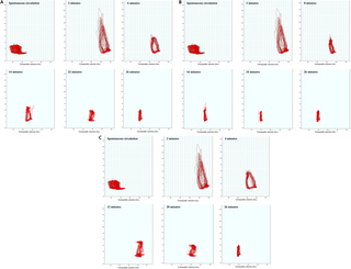 Objectives To investigate right ventricular hemodynamics and determine how vena cava occlusion (VCO) influences right ventricular pressure–volume dynamics during cardiopulmonary resuscitation (CPR).   Methods We used a swine model of electrically induced vent…