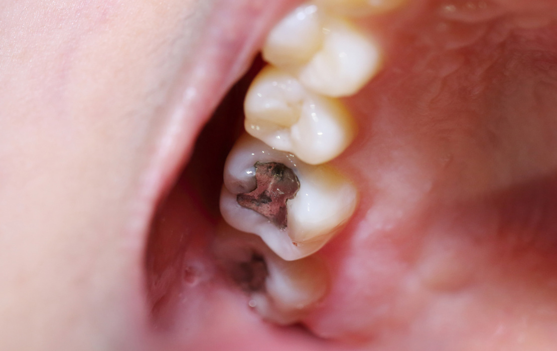 In response to the announcement, the ADA said it continues to support the use of dental amalgam&nbsp;based on dentists' clinical judgment.