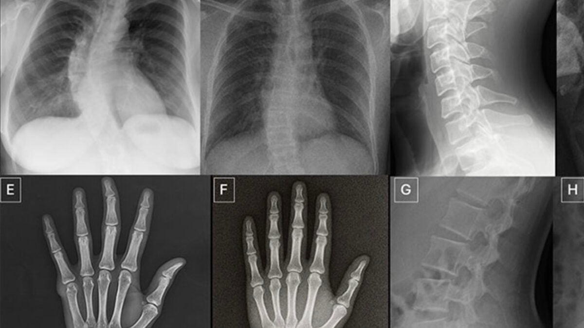 In tests, radiologists struggled to discern genuine X-rays from AI-generated fakes.