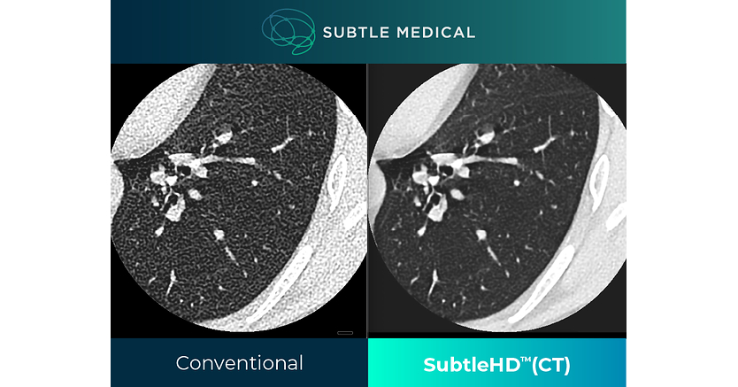 New software enhances CT image quality across scanner generations, supporting radiologists with improved image clarity and consistency MENLO PARK, Calif., June 10, 2026 /PRNewswire/ -- Subtle Medical, a leader in AI-powered medical imaging software, today ann…